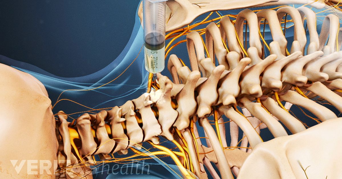 Inyeccion para hernias discales